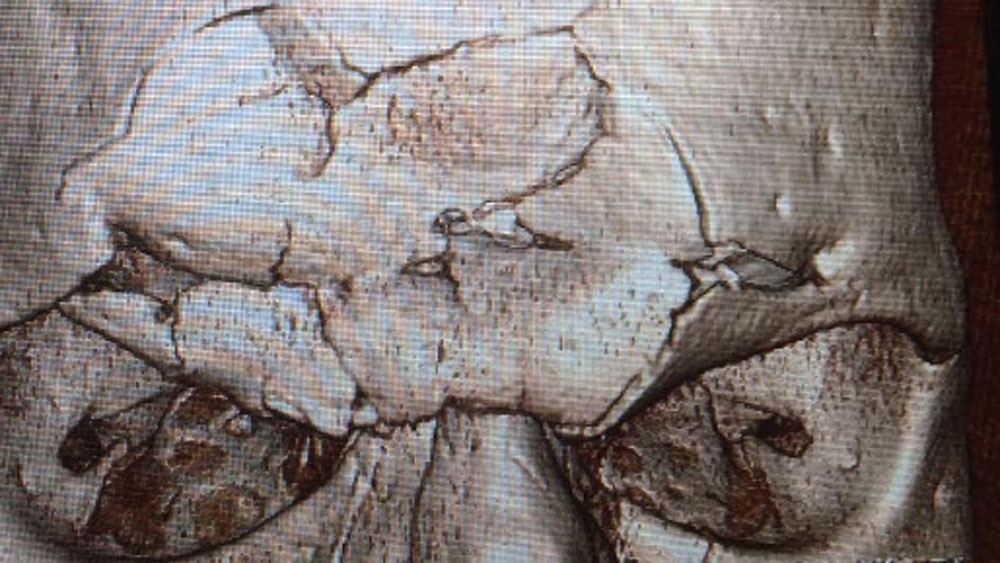 Horrific crack as MMA fighter's skull fractures - News