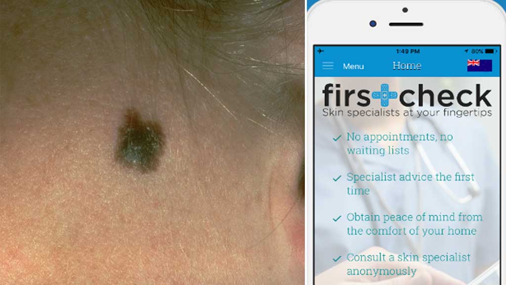 cancer skin finger detect melanomas app