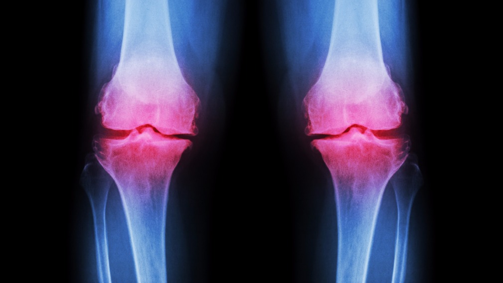 Drug breakthrough being used to treat osteoarthritis