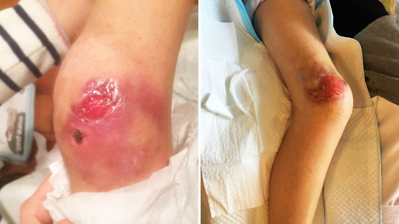 Girl struck down with flesh-eating disease mysteriously plaguing Victoria Girl struck down with flesh-eating disease mysteriously plaguing Victoria
