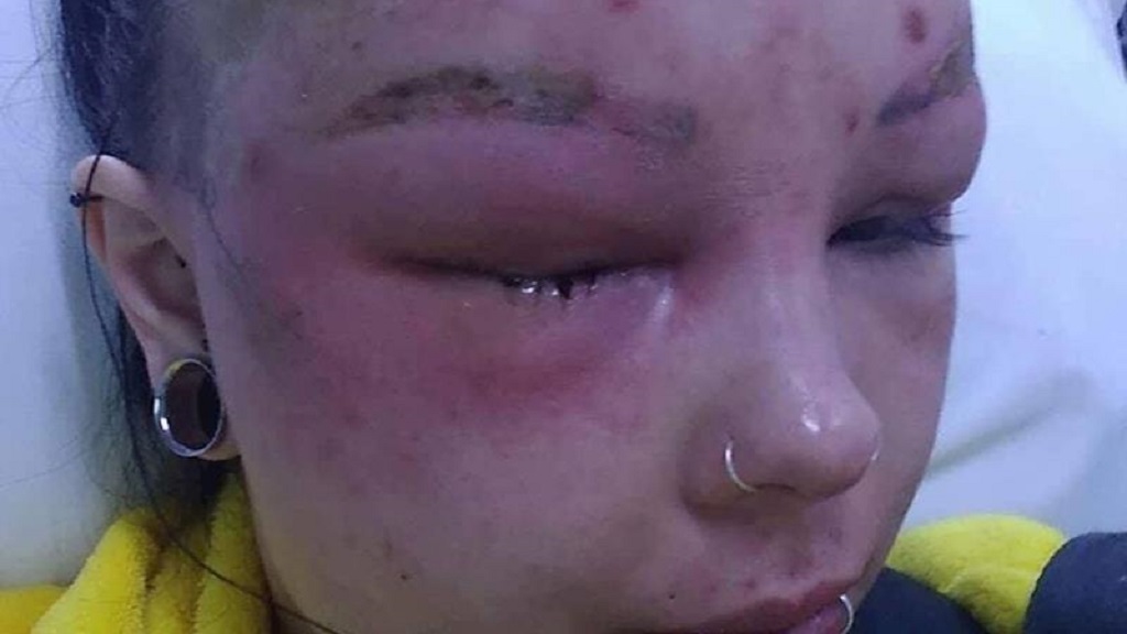 Woman Suffers Severe Allergic Reaction To Waxing I Look
