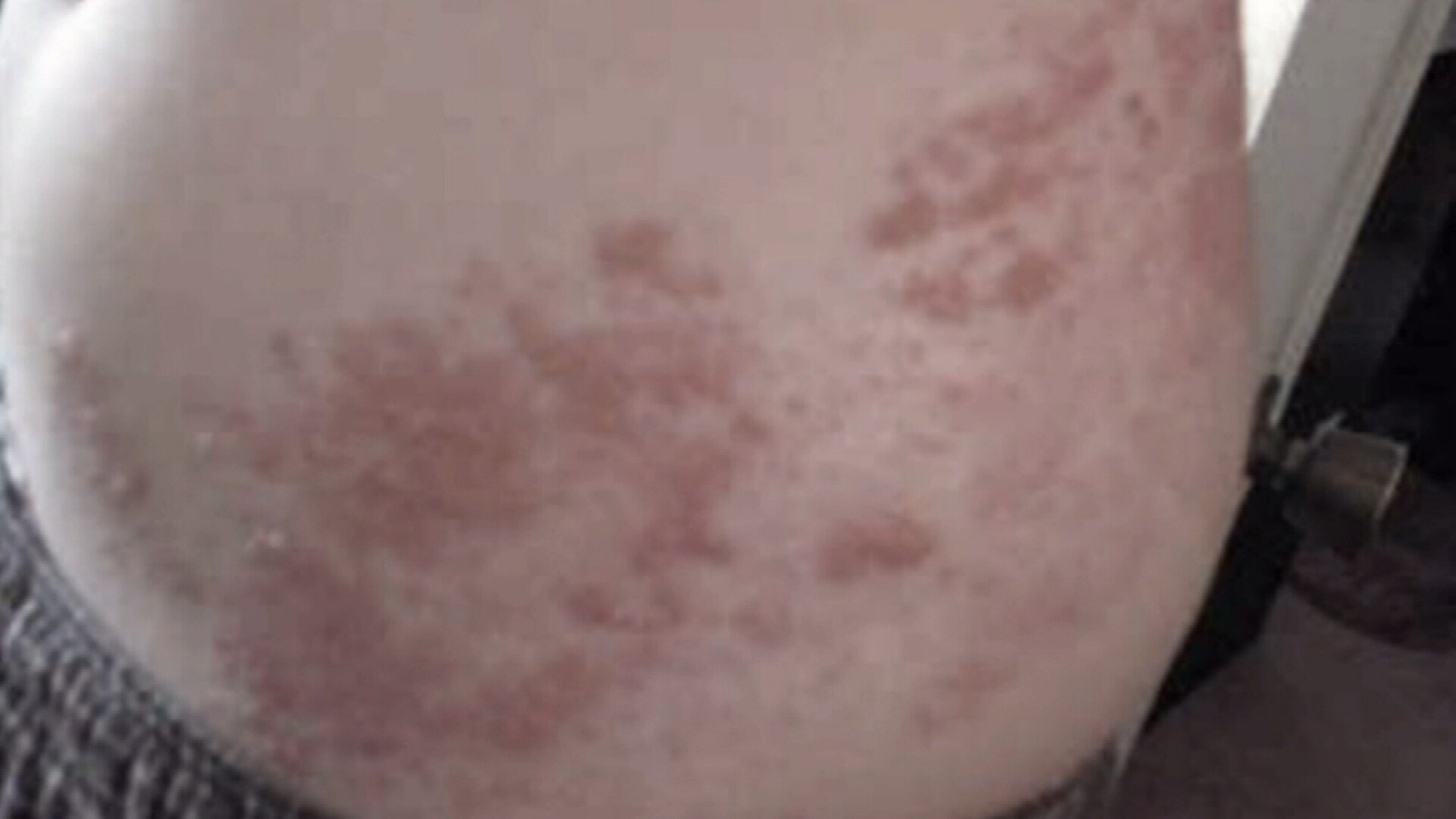 after effects of shingles inback after effects of shingles inback