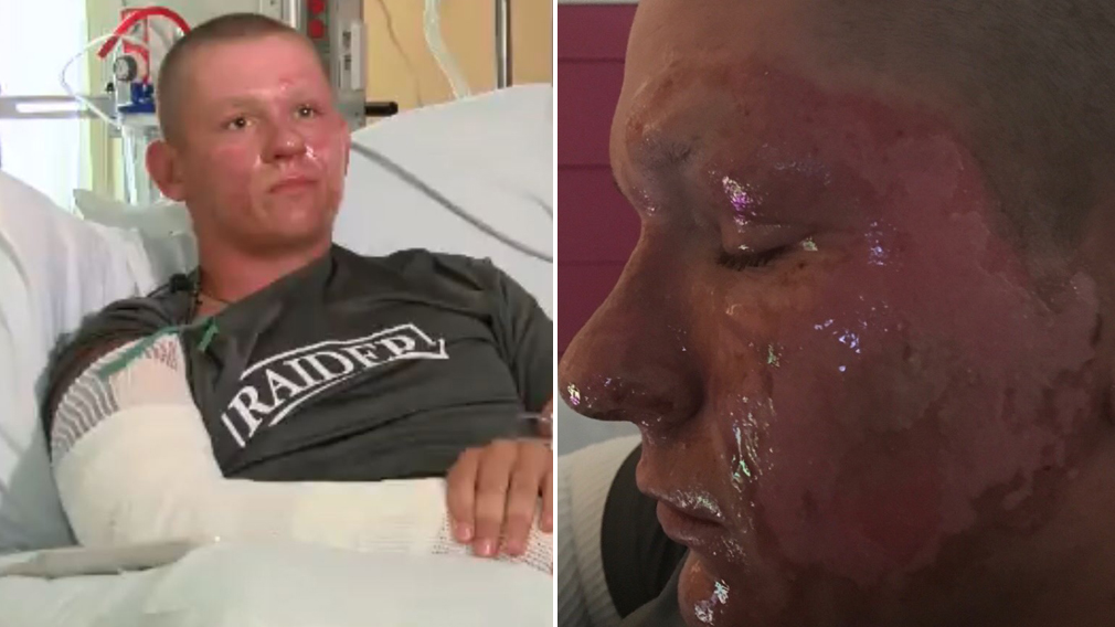 Virginia teen's brush with weed causes skin on his face to melt off
