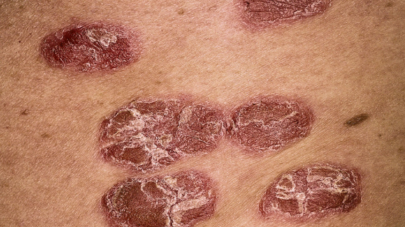 New treatment for psoriasis