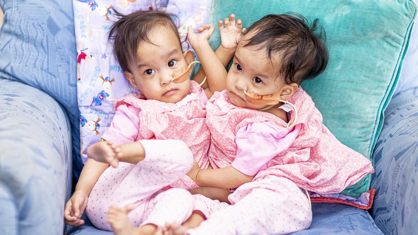 separated-conjoined-twins-remain-close-in-melbourne-hospital