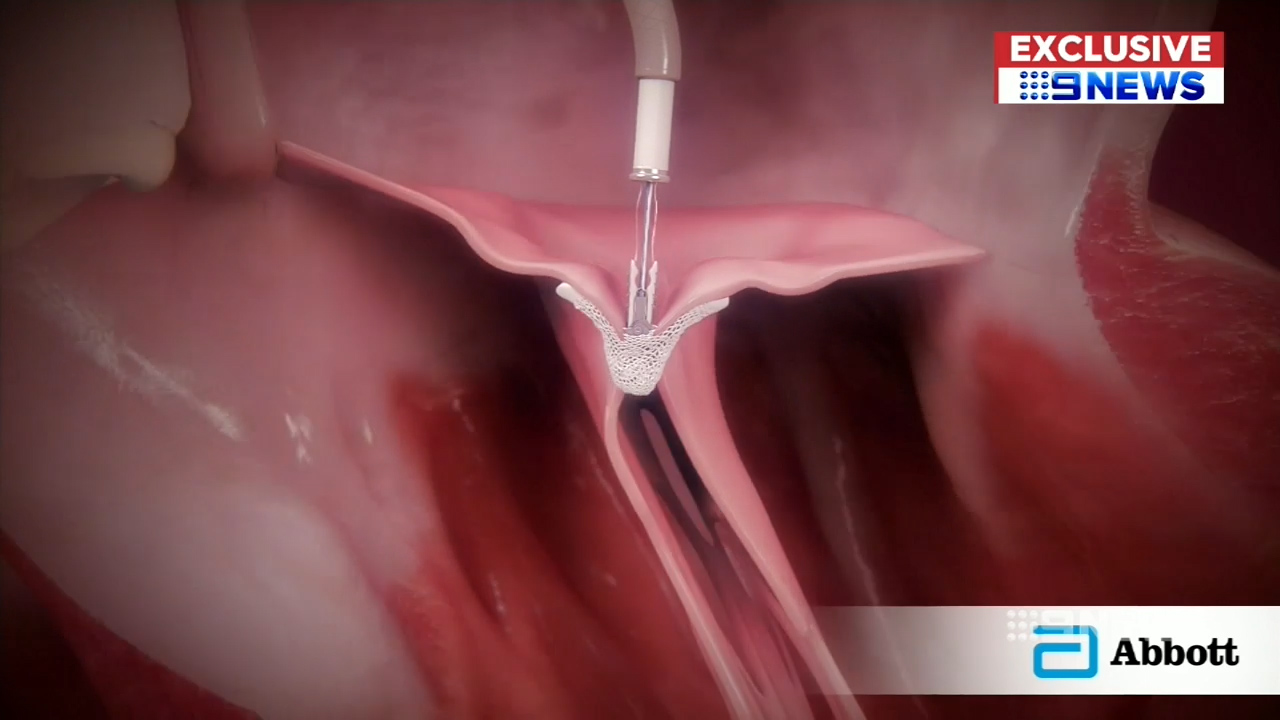 Tiny device could improve survival rates after heart failure