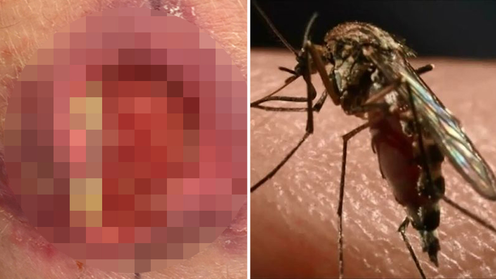 Buruli Ulcer: Flesh-eating disease warnings issued as new Queensland cases identified
