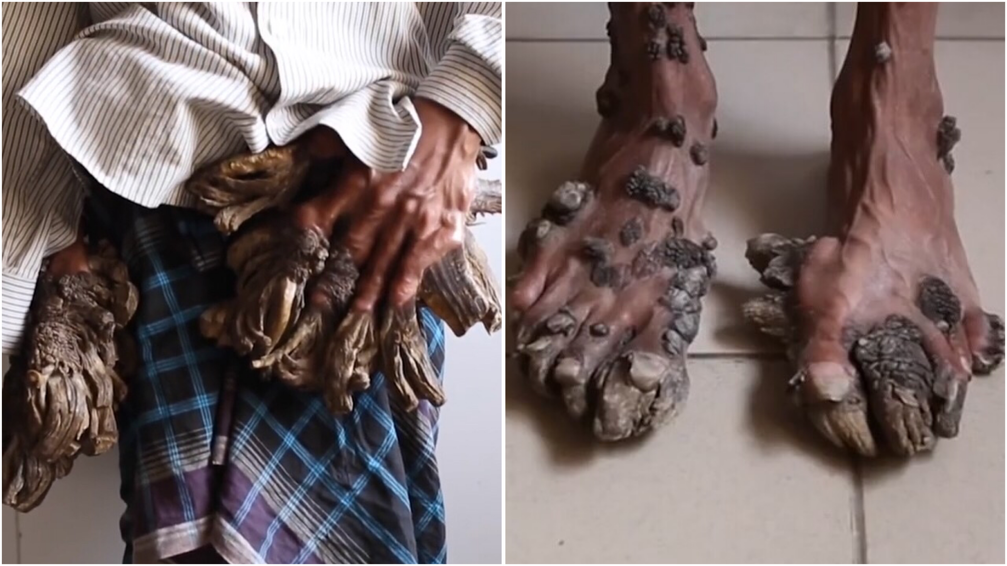 Asia news: Bangladeshi tree man requires more surgeries on growths