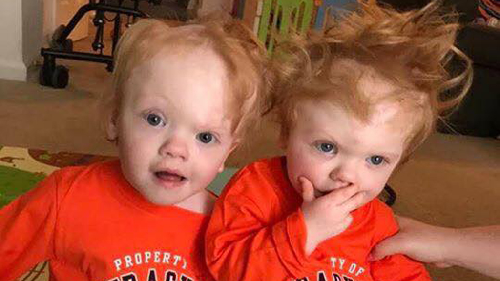 Delaney twins once joined at the head "thriving" 9Honey