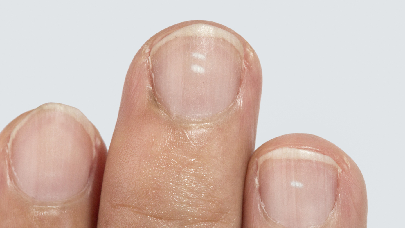 White spots on the nails, the fact that it is from a lack of vitamins is one thing. and there are any signs of this 92 White spots on the nails, the fact that it is from a lack of vitamins is one thing. and there are any signs of this 20