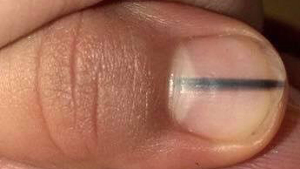 Manicurist Spots A Dark Stripe On A Nail That Turned Out To Be Cancer 