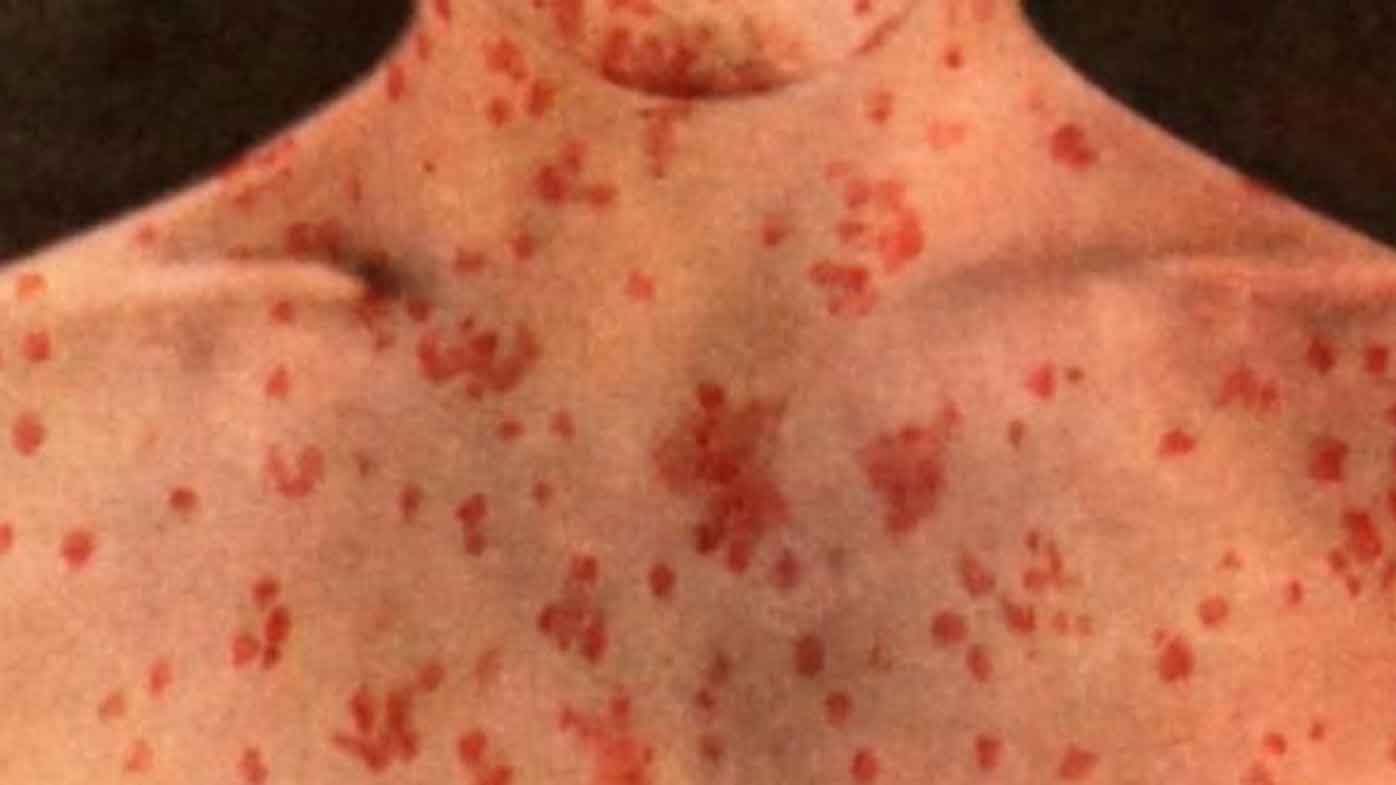 Measles warning for Melburnians after man infected overseas