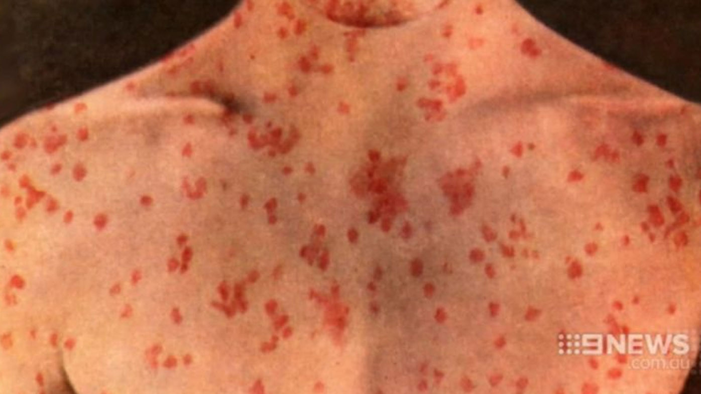 Measles alert after man contracts disease on flight