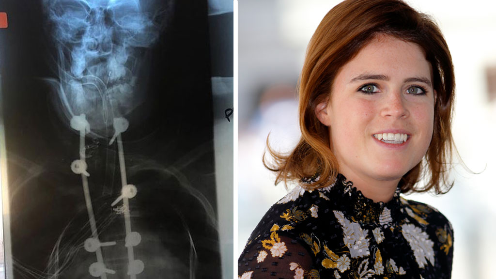 Princess Eugenie Shares Scoliosis Surgery Story 9honey 