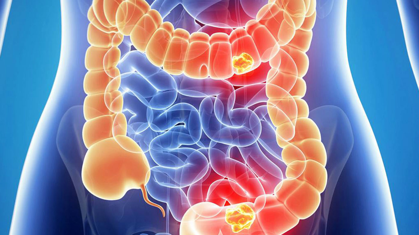 health-news-bowel-cancer-testing-should-target-younger-people-experts-say