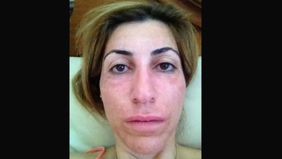 Mary Moujaber three months after her laser treatment. Her skin is still showing signs of pigmentation and redness.