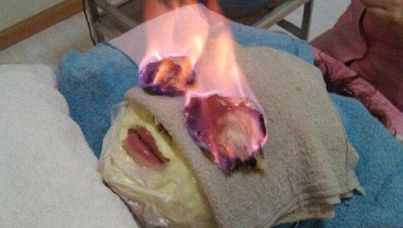 Woman receiving a Chinese "fire facial". 