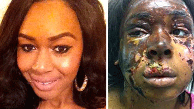 London retail assistant Naomi Oni, 20, before and after she fell victim to an acid attack.