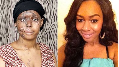 Acid victim Naomi Oni before and after the attack.