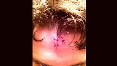Wrestler Michael McComish has tweeted a photo of his injury. 