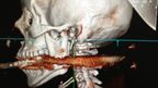 A digital image of the harpoon showing how close it came to piercing her spine. 