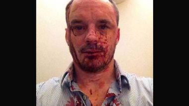 A photo of Christopher Bryant after the attack.