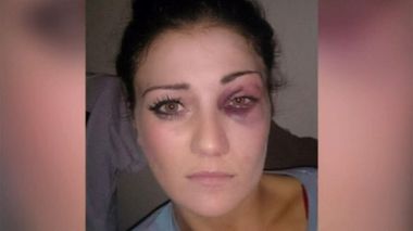 Katie Lewis claims she was bashed by South Sydney forward Ben Te'o. (Nine News)