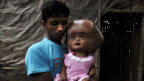 Abdul Rahman holds his 18-month-old daughter, Roona Begum, suffering from Hydrocephalus, a buildup of fluid inside the skull that leads to brain swelling. (Getty)