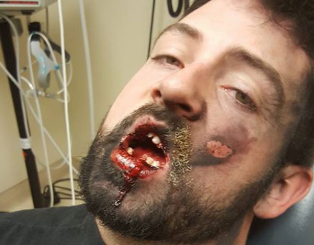 US man left with devastating injuries after e-cigarette explosion