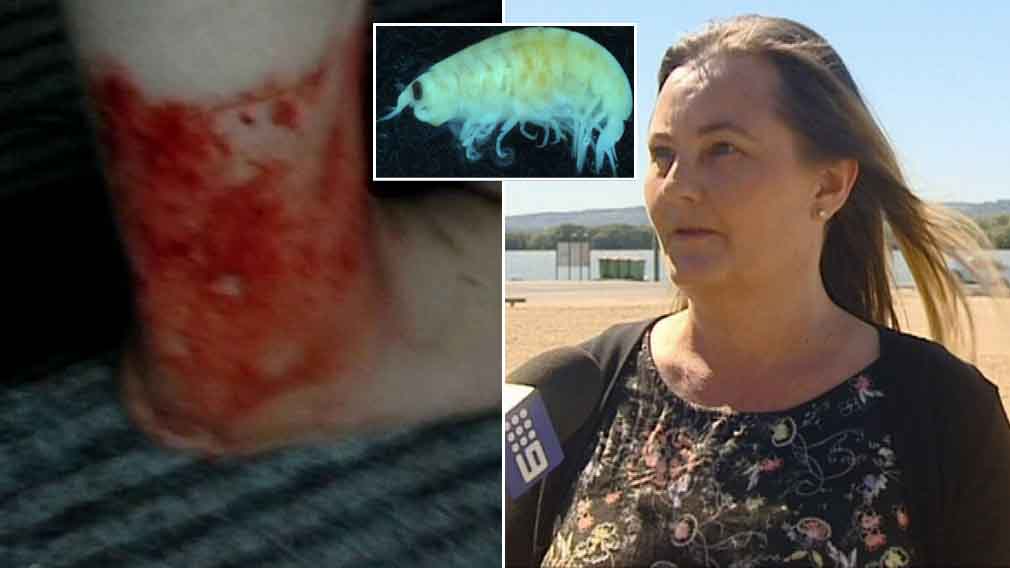 Gold Coast woman savaged by similar 'sea creatures' to Melbourne teen