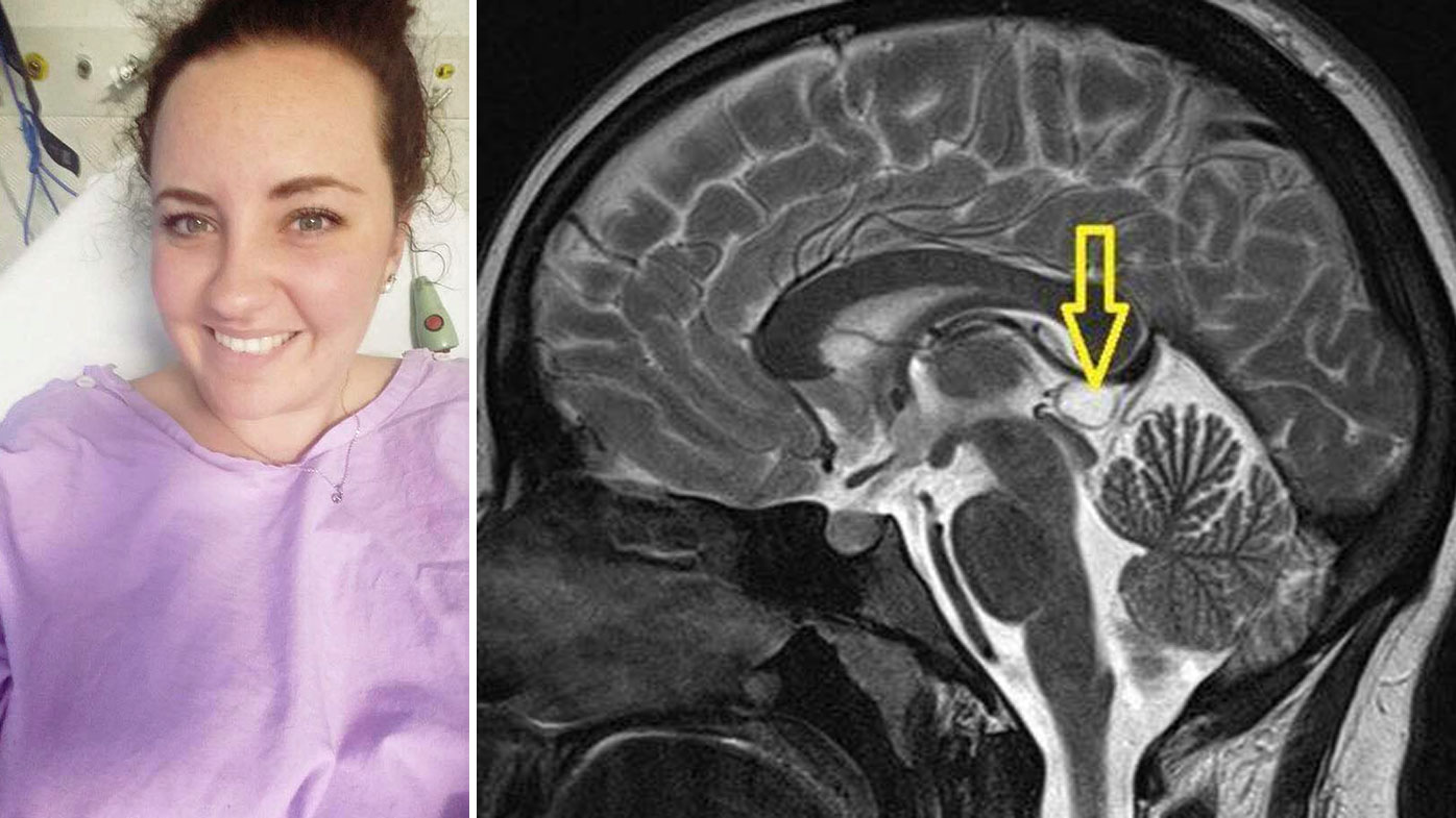 Life Saving Pineal Cyst Surgery For Pregnant Queensland Woman Out Of Reach At 85k
