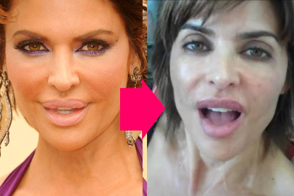 The trout pout is gone! Lisa Rinna gets her lips deflated - 9Celebrity