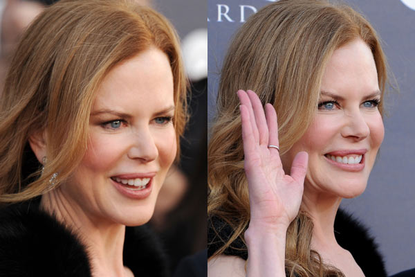 Nicole Kidman Botox Face