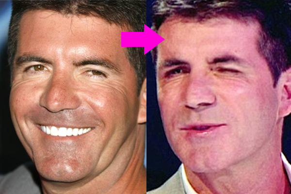 Botox? Simon Cowell shocks TV viewers with droopy eye - 9TheFix