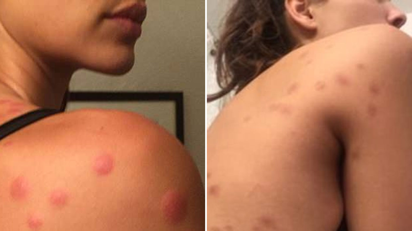 Victoria S Secret Model Sues Hotel Over Bed Bug Bites 9honey