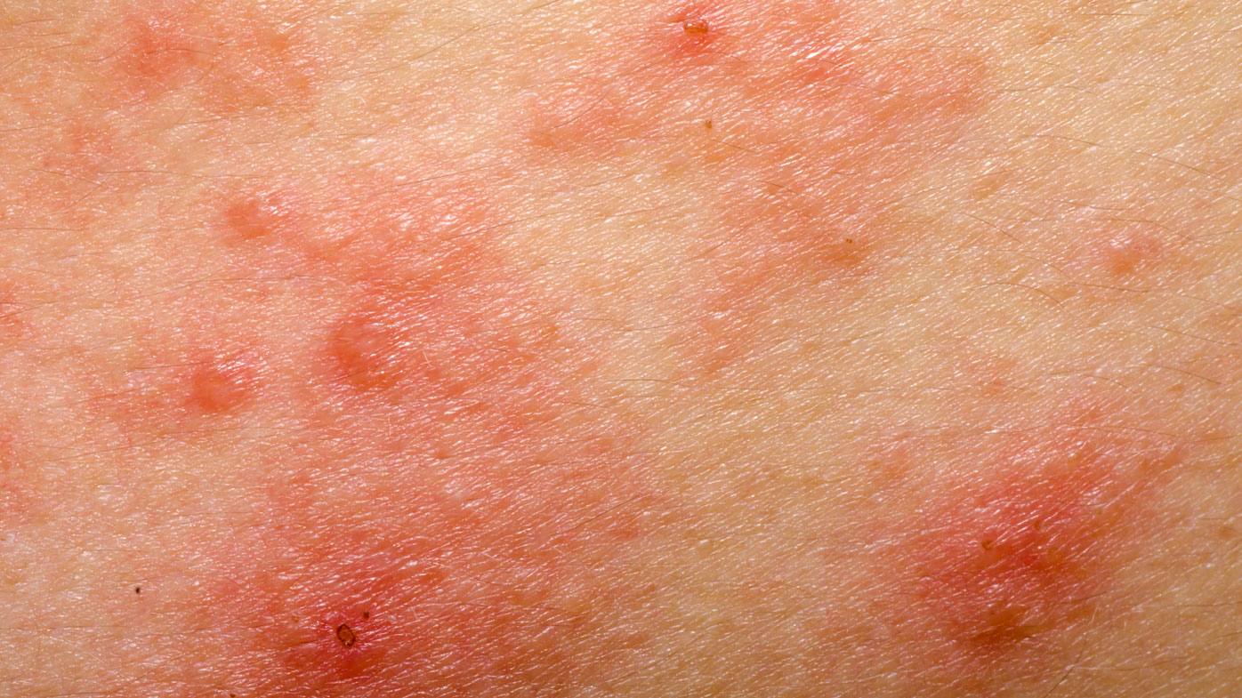 How to identify common eczema triggers - 9Coach