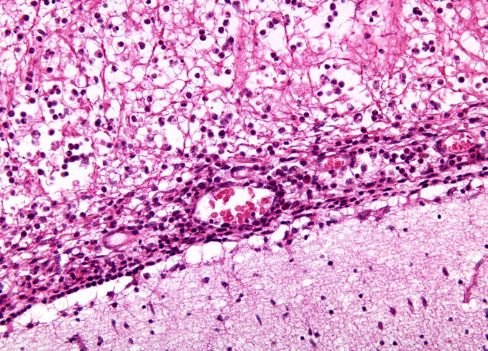 The warning comes as annual meningococcal cases surpass 100 nationally.