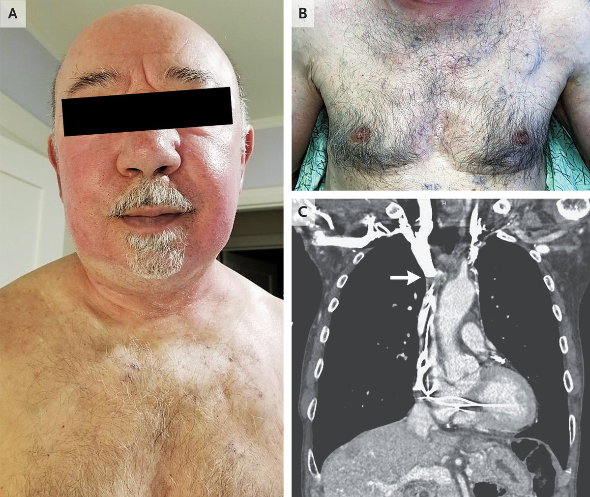 The man, aged 75, went to a dermatology clinic with erythema of the face, which doctors later found was linked to his pacemaker.