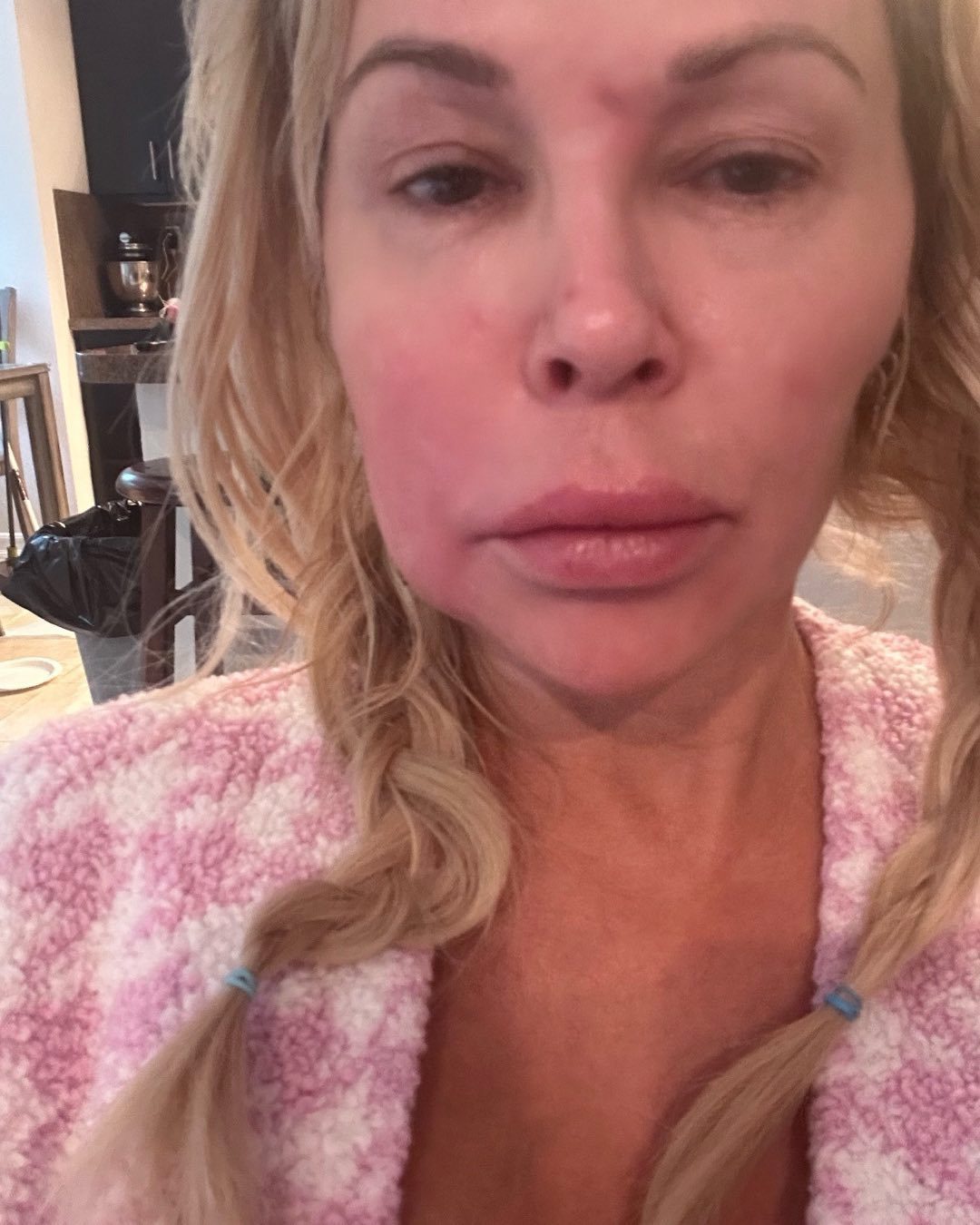 Brandi Glanville face disfigurement