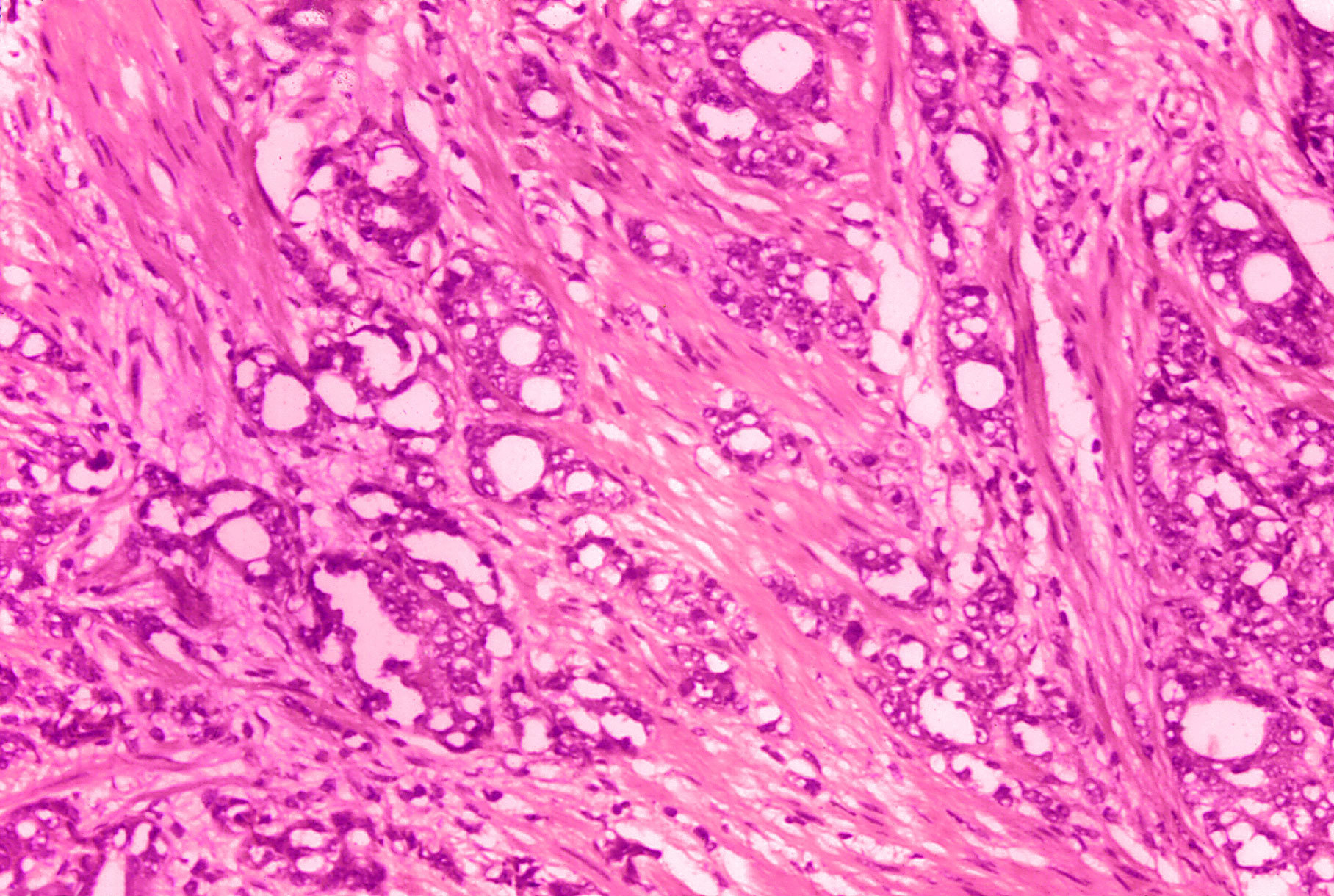 A microscope image shows changes in cells which are indicative of prostate cancer.