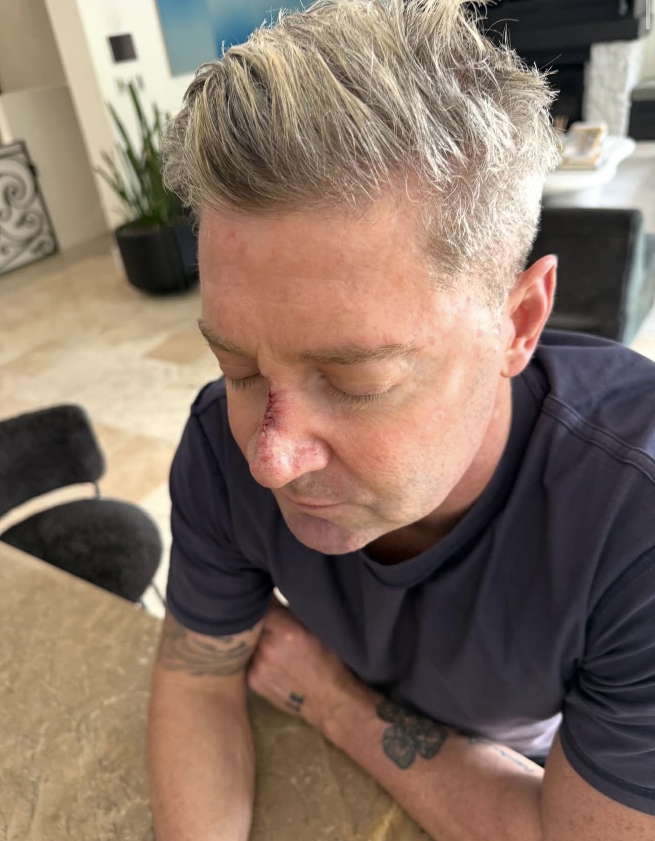Michael Clarke skin cancer