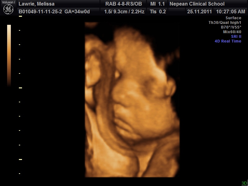 Pregnancy scan Melissa