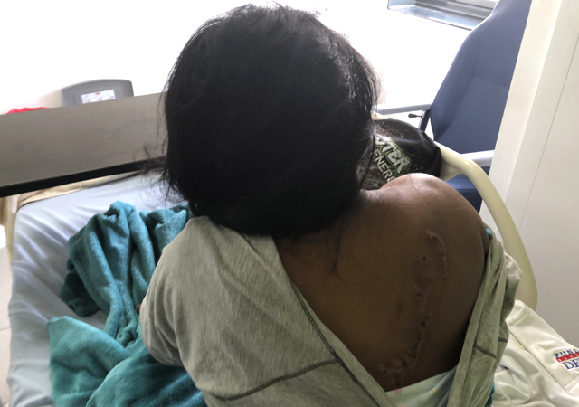 Dina Blanco show injuries on her back during an interview at Luis Fabrega Hospital in Santiago, Panama. The survivor of a cult ceremony that killed seven people in her remote village in Panama says she was ordered to close her eyes, was beaten and knocked unconscious during the ritual. 