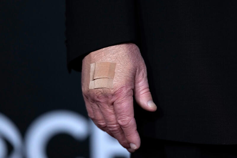 A bandage is seen on the hand of President Donald Trump while he walks the red carpet before the 48th Kennedy Center Honor