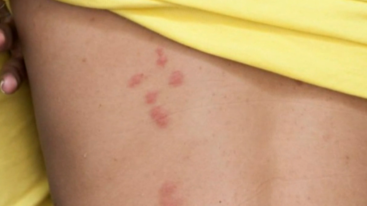 A strain of monkey pox has been detected for the first time in Queensland and second time ever in Australia.
