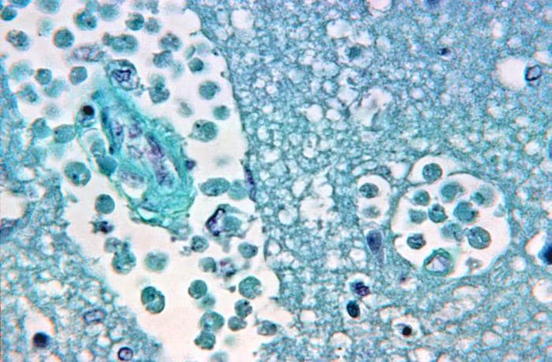 A brain tissue specimen after a Naegleria fowleri amoebic infection.