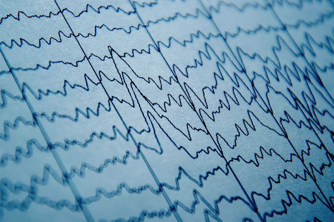 Las grabaciones de EEG mostraron niveles elevados de rayos gamma en ciertas partes del cerebro a medida que las personas sufrían paros cardíacos.