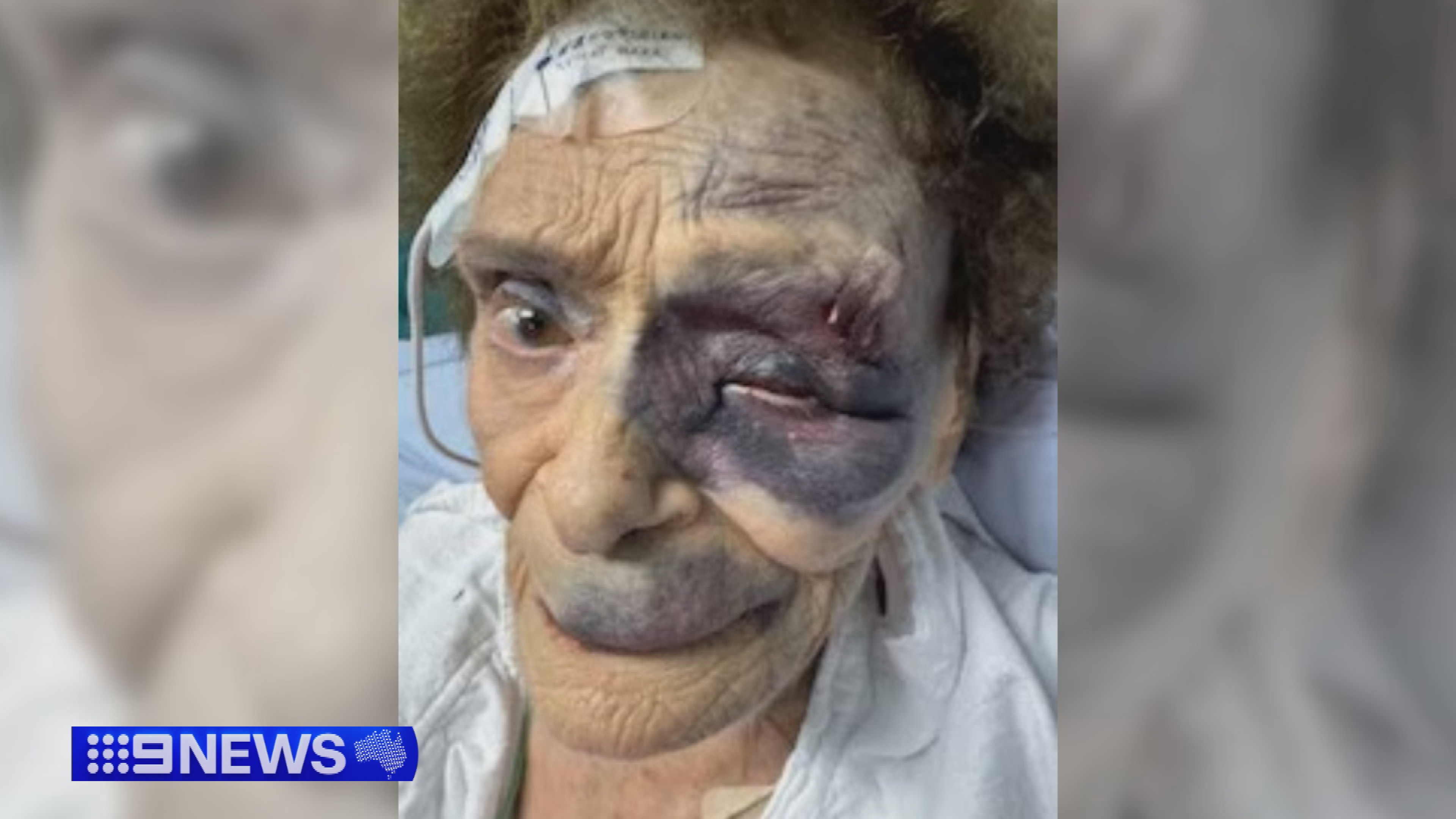 The 91-year-old suffered a broken pelvis and brain bleed after falling at home.