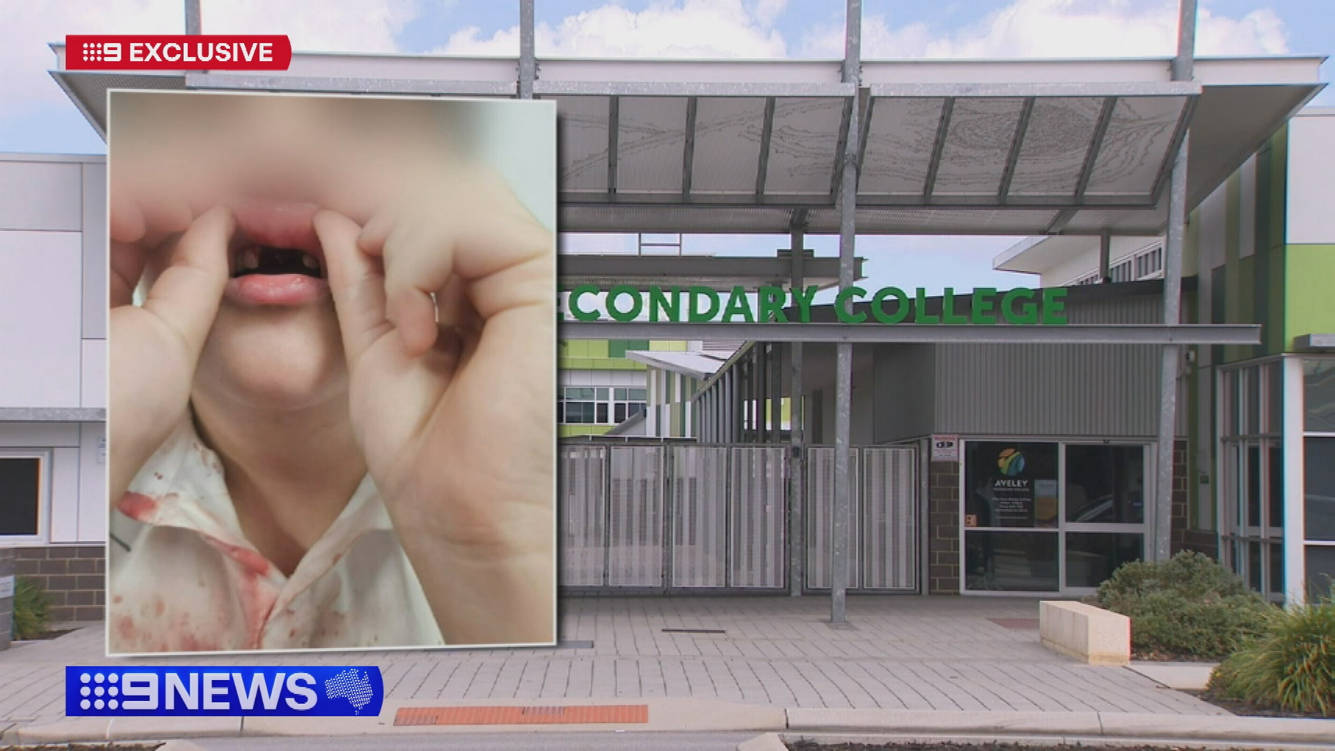 Alleged school bashing leaves 14-year-old without two front teeth