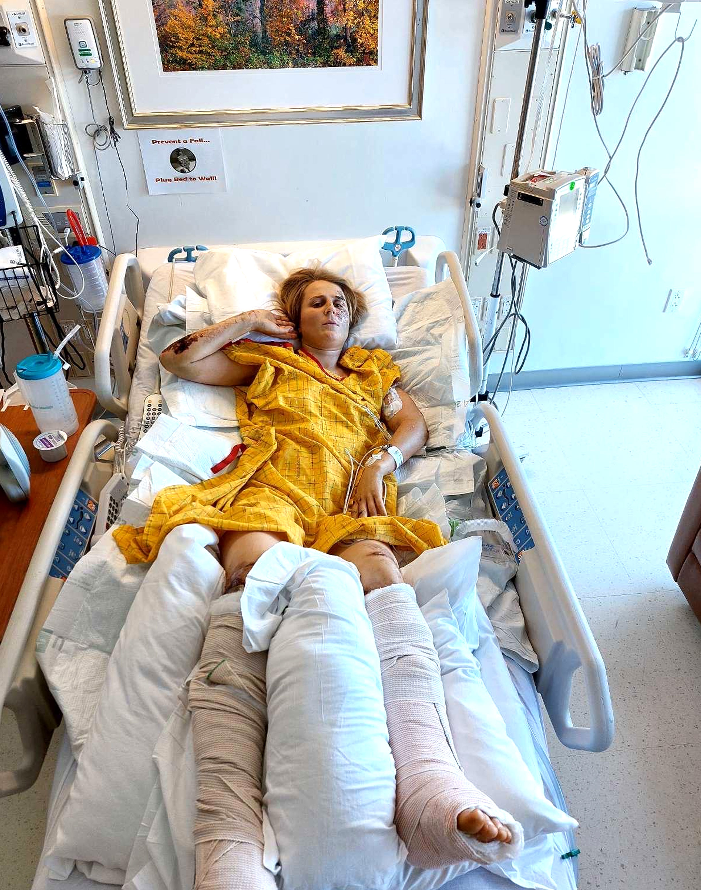 La escaladora neozelandesa Anna Parsons yace en una cama de hospital en California.